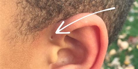 Have You Seen Someone With A ‘tiny Hole Above Their Ears This Is What