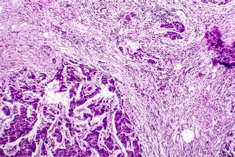 Lymph Node Metastasis Stock Photo Image Of Pathohistology 120405102