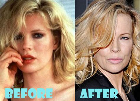 Kim Basinger Plastic Surgery Before And After Pictures Lovely Surgery