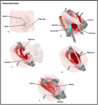 What is the recovery like for hiatal hernia surgery? answered by dr. Femoral Hernia Repair - procedure, recovery, blood, pain, complications, adults, time, infection