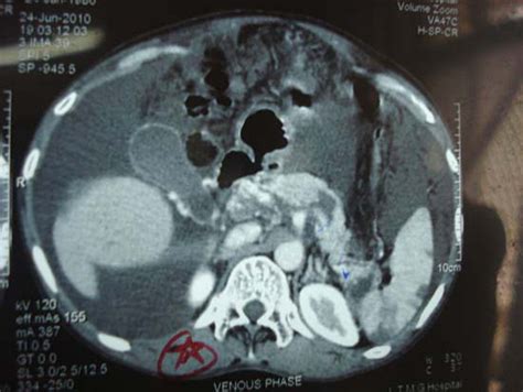 Pancreatic Ascites In The Setting Of Portal Hypertension Bmj Case Reports
