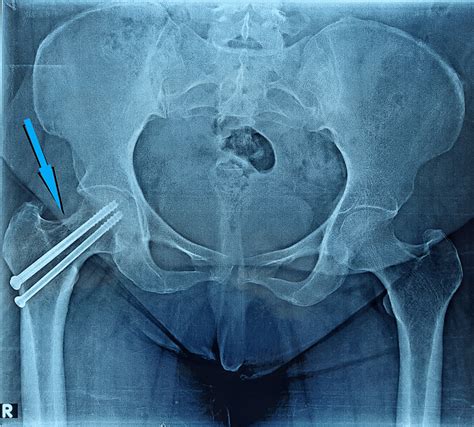 Cureus Stress Fracture Of The Femoral Neck Following Total Knee