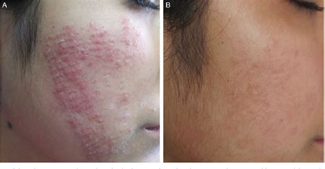 Figure 2 From A Cutaneous Reaction To Microneedling For Postacne
