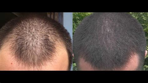 1 Year Minoxidil Hair Regrowth Results Before And After 2013 Youtube