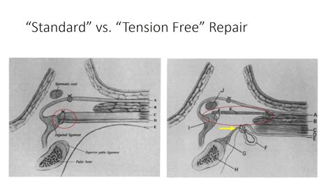 Literature Review The Tension Free Hernioplasty Lichtenstein Repair