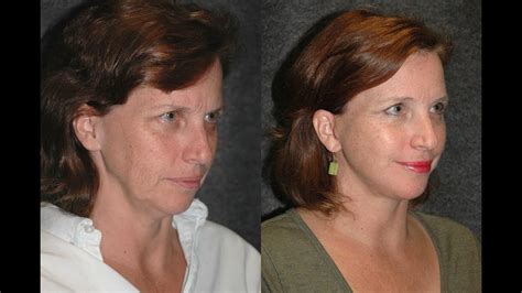 Mini Facelift Before And After On 51 Year Old Woman Dr Andrew Jacono