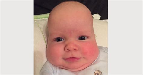 Babys Odd Head Shape Signaled Serious Medical Condition Cbs News