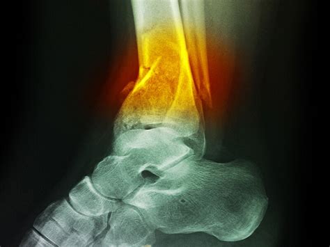 Cast Technique May Help Elderly Avoid Ankle Fracture Surgery