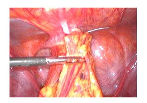 Iud meaning, definition, what is iud: Laparoscopic view of migrating IUD embedded in the ...
