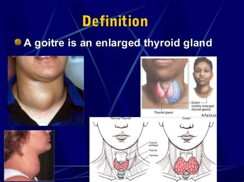 Surgical Aspects Of Goitre