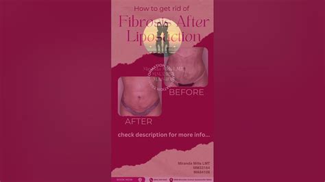 Fibrosis After Liposuction Youtube