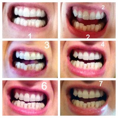 Overbite (also known as deep bite) is an extremely common dental condition that is often unnecessary to correct, but some people seek treatment in order to feel more comfortable with their smile. Invisalign with Elastics for Crowding, Midline Correction ...