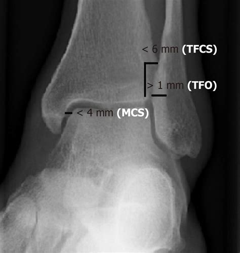 Acute Syndesmotic Injuries In Ankle Fractures From Diagnosis To