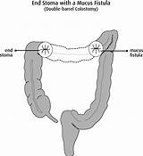 Images of Colorectal Fistula Treatment