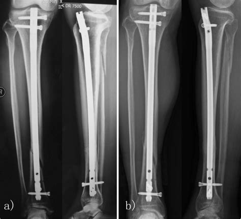 Delayed Union Of Tibia Fracture Treated With Pemf A A Delayed Union