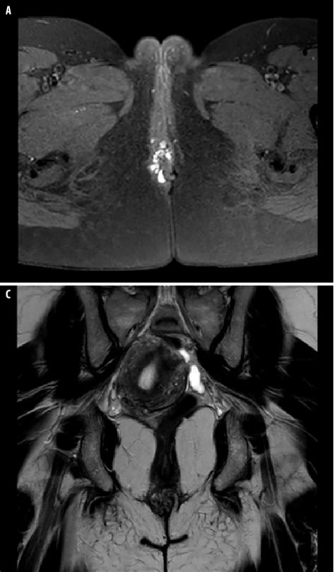 Pelvic Mri Shows Right Perineal Lesion A Axial T1 Weighted Image