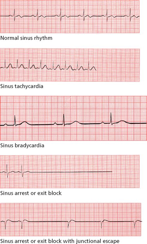 Arrhythmias Thoracic Key