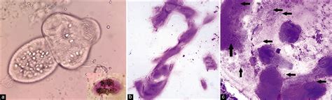 Rapid Onsite Cytologic Evaluation And Diagnosis Of Hydatidosis From