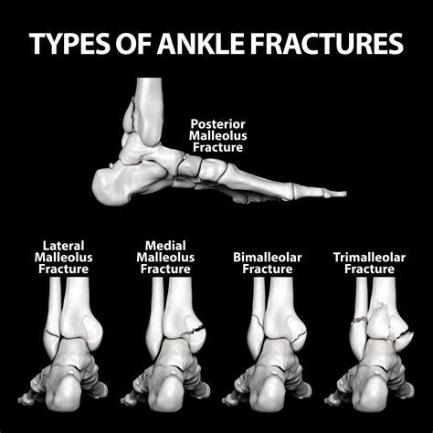 Trimalleolar Ankle Fracture Recovery