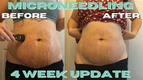 Microneedling My Stretch Marks 4 Week Update Part Two Youtube