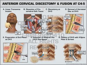 Anterior Cervical Discectomy Fusion At C C Print Quality Instant