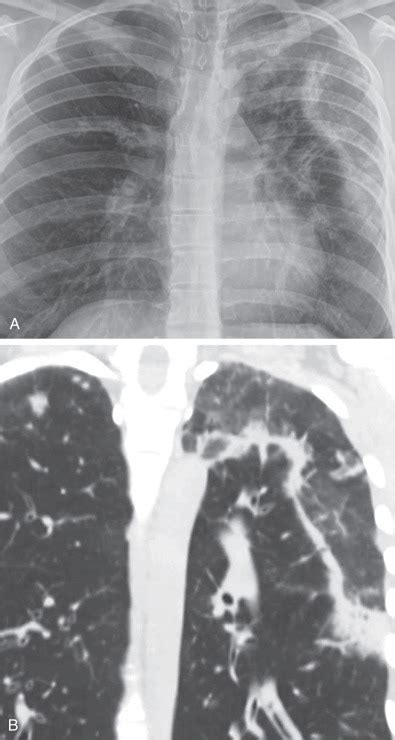 Eosinophilic Lung Diseases Radiology Key