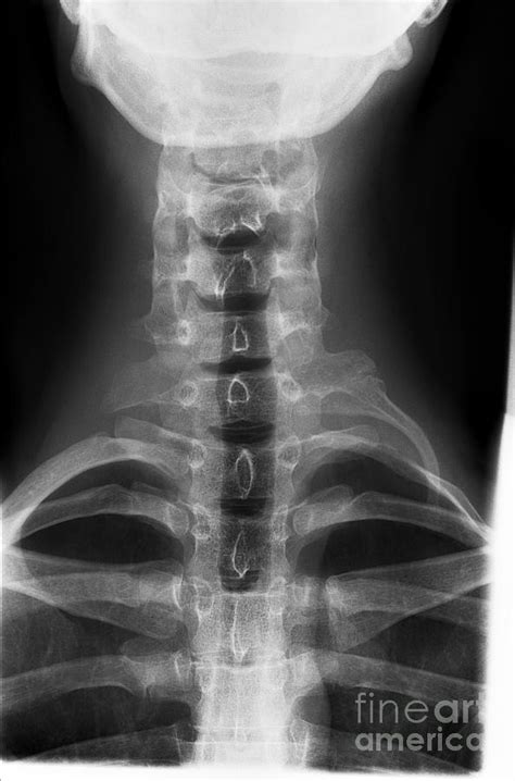 Cervical Rib X Ray Photograph By Science Photo Library