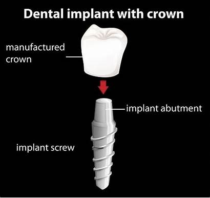 Implant Dental Implants Fixture Abutment Pieces Broken