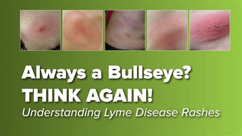 Think The Lyme Disease Rash Is Always A Bullseye Think Again Johns