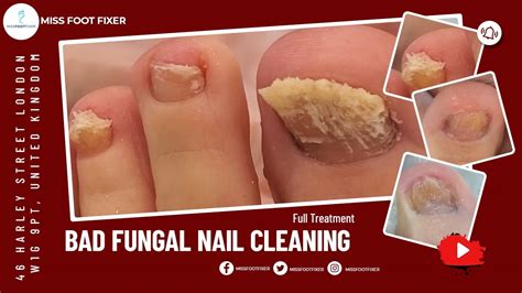How To Treat Bad Fungal Nail Infection Full Treatment By Miss Foot