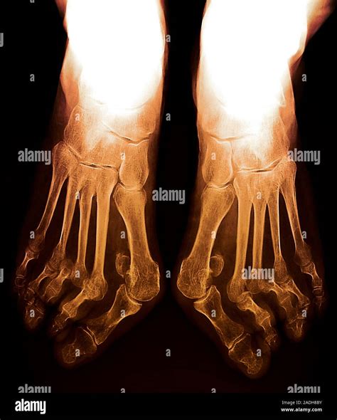Arthritic Feet Coloured X Ray Of The Feet Of A 72 Year Old Patient