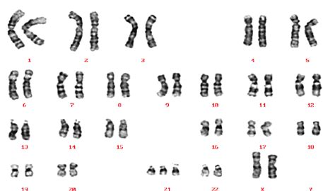 A Karyotype Of A Down Syndrome Patient Xx Reproduced