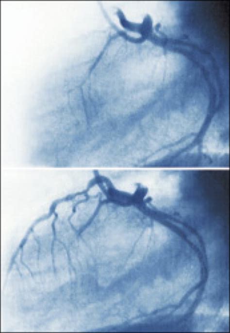 International Comparisons Of Acute Myocardial Infarction Authors