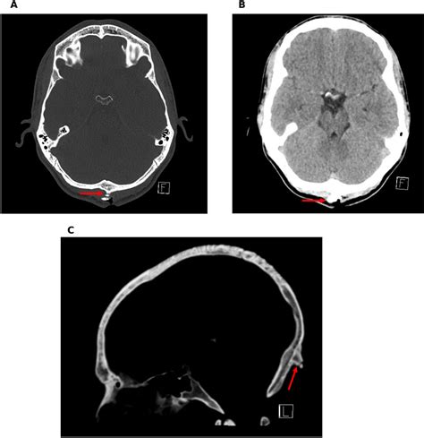 Presentation And Management Of Traumatic Occipital Spur Fracture The