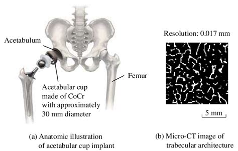 Acetabular Cup Implant In Total Hip Joint Arthroplasty Download