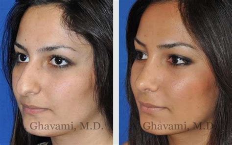 Before After Nose Surgery Pictures In Beverly Hills Los Angeles Dr