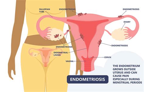 black women and endometriosis resilient sisterhood project