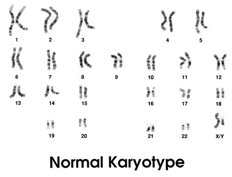 What Is The Difference Between Normal And Abnormal Karyotype Pediaa