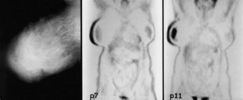A 45 Year Old Patient Presented With A 14 Cm615 Cm Carcinoma Of The
