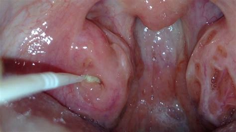 Several Large Tonsil Stones Being Removed Youtube