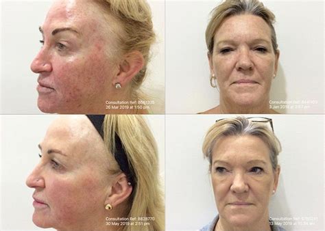 Pdt Photo Dynamic Therapy Treatments Of Superficial Skin Cancers Oo