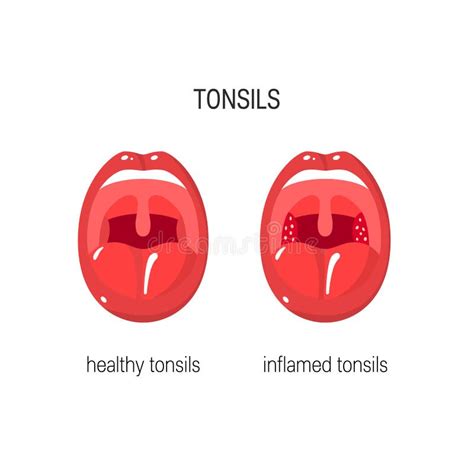Tonsils Vector Illustration Tonsillitis Labeled Structure Diagram