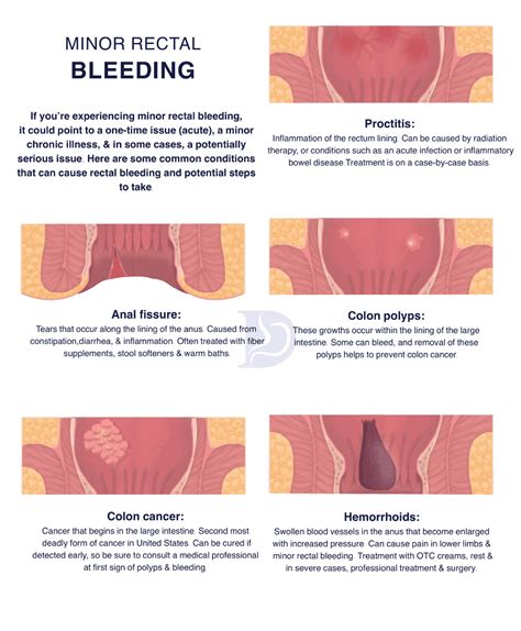 Rectal Bleeding Digestive And Liver Health Specialists