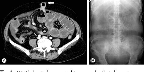 Figure 1 From Incarcerated Umbilical Hernia With Small Bowel