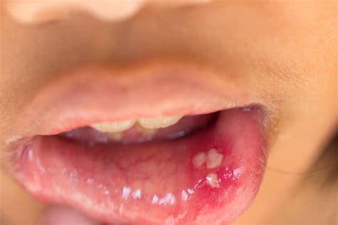 50 Aphthous Stomatitis Stock Photos Pictures And Royalty Free Images