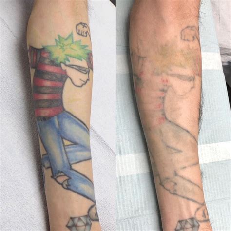 Laser Tattoo Removal Vancouver Bc Adrenaline Studios