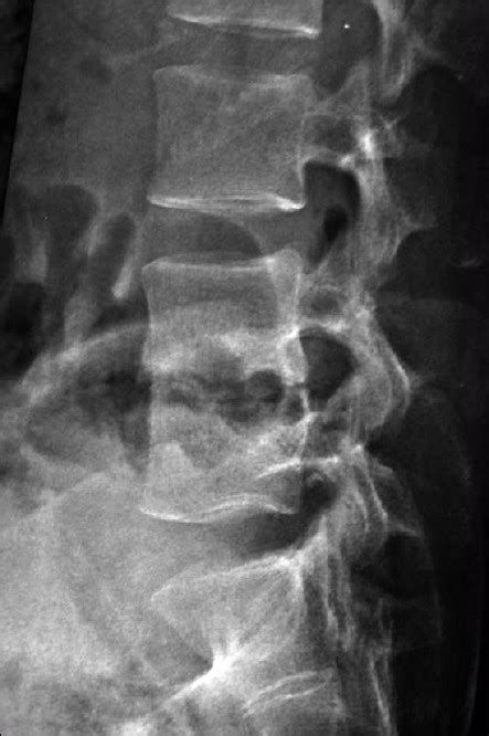 X Ray Of Lumbar Spine Lateral View Depicting Lytic Le Open I