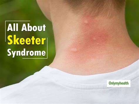 Skeeter Syndrome Treatment Land To Fpr
