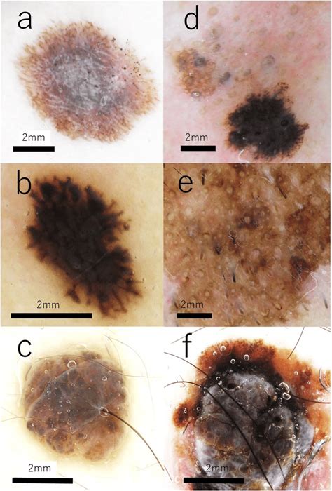 Dermoscopic Images Of Pigmented Lesions A Nevus1 Spitz Nevus 7