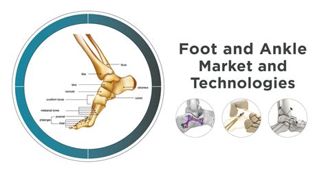 Infographic Foot And Ankle Market And Technologies Bonezone